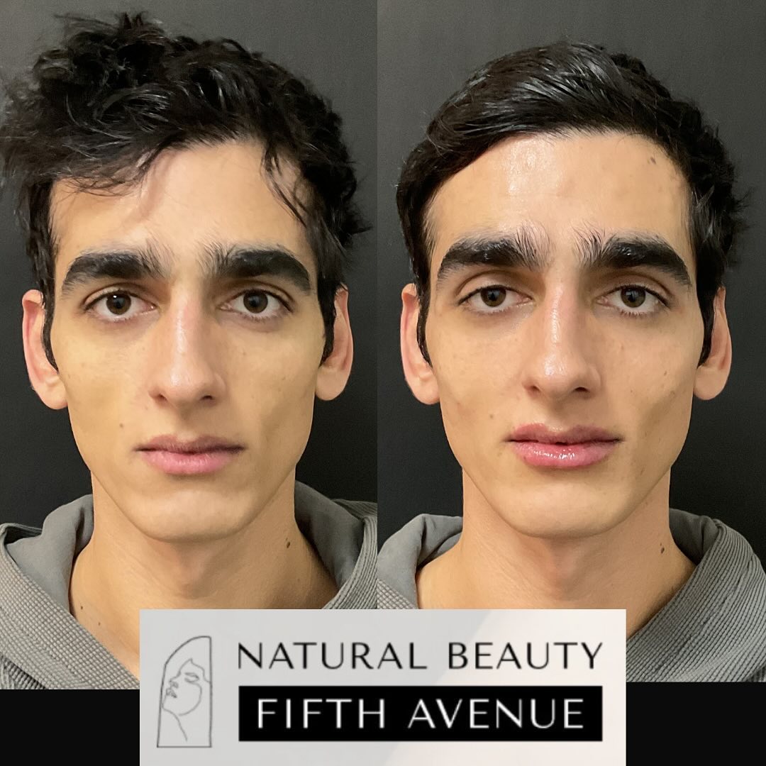 Before and after dermal fillers treatment showing enhanced facial volume and lip definition